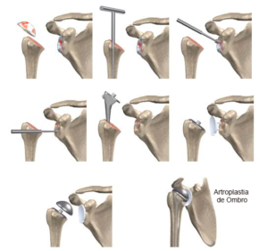 Artroplastia de Ombro