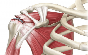 Tendinite do Manguito Rotador