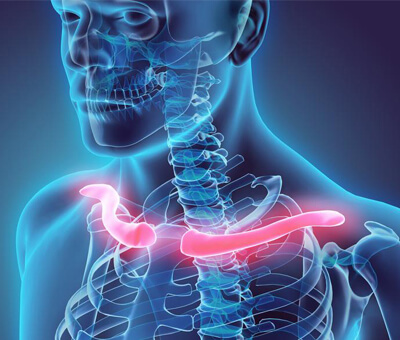 Luxação Acromioclavicular