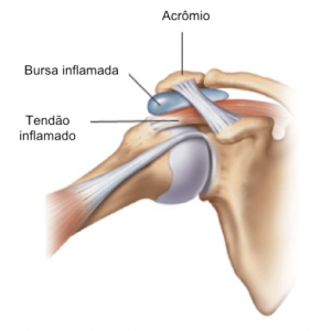 lesões no ombro
