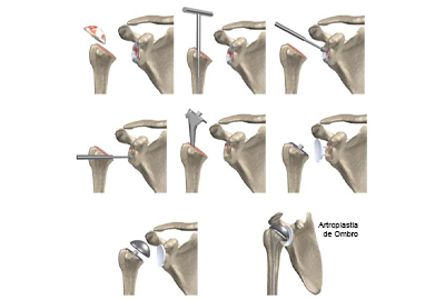 Artroplastia de Ombro