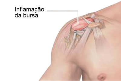 Bursite no Ombro